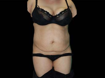 Tummy-Tuck-after-45-54-year-old-woman-front-before