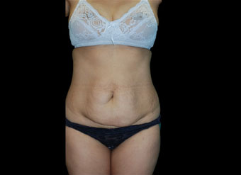 35-44-Tummy-Tuck-before-front